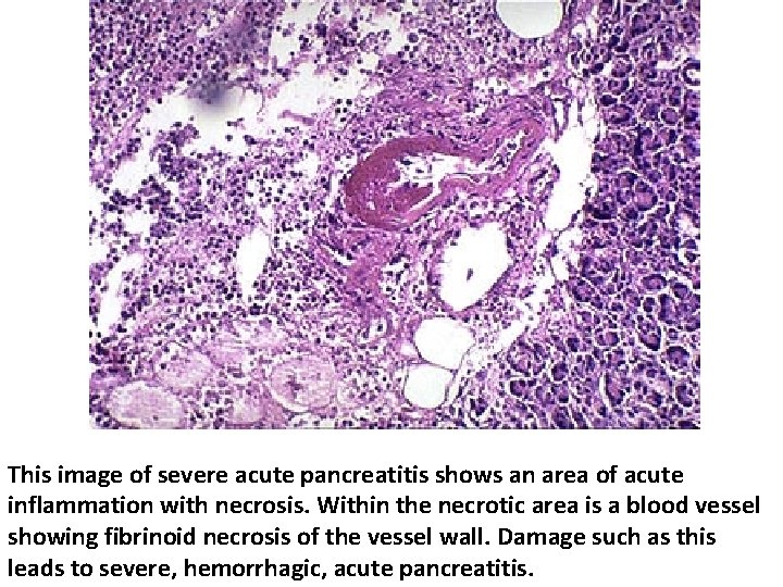 This image of severe acute pancreatitis shows an area of acute inflammation with necrosis.