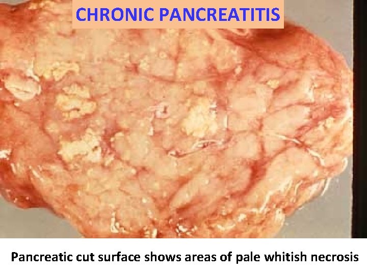 CHRONIC PANCREATITIS Pancreatic cut surface shows areas of pale whitish necrosis 
