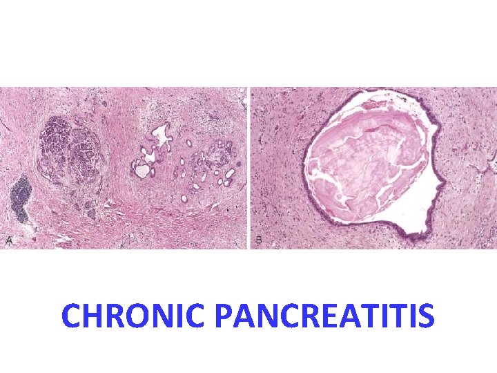 CHRONIC PANCREATITIS 