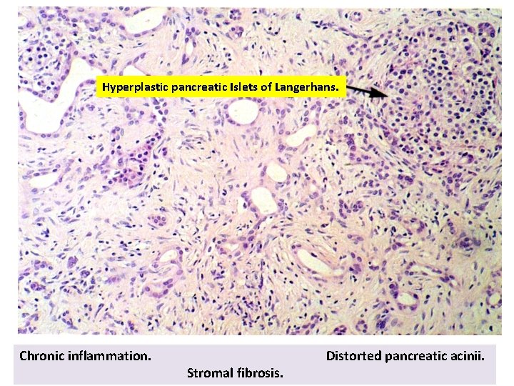 Hyperplastic pancreatic Islets of Langerhans. Chronic inflammation. Stromal fibrosis. Distorted pancreatic acinii. 