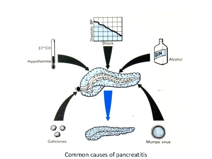 Common causes of pancreatitis 