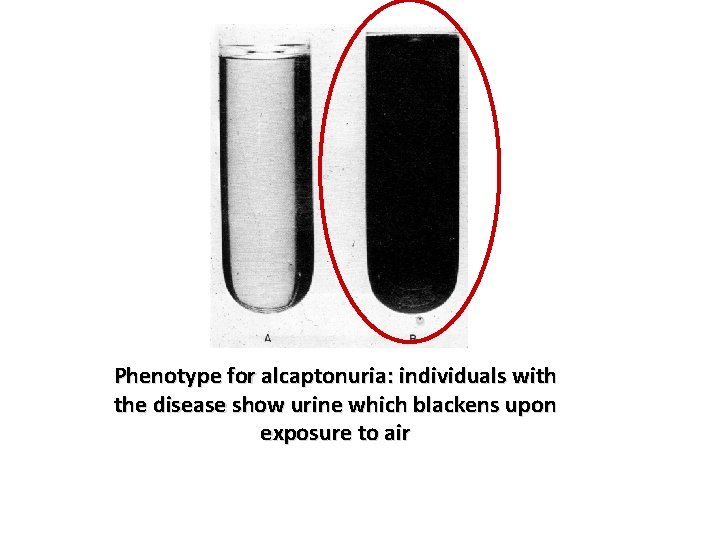 Phenotype for alcaptonuria: individuals with the disease show urine which blackens upon exposure to