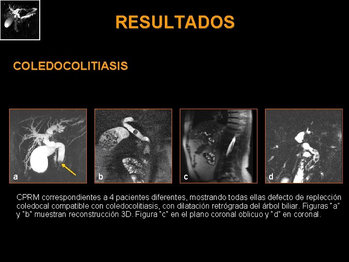 RESULTADOS COLEDOCOLITIASIS a b c d CPRM correspondientes a 4 pacientes diferentes, mostrando todas