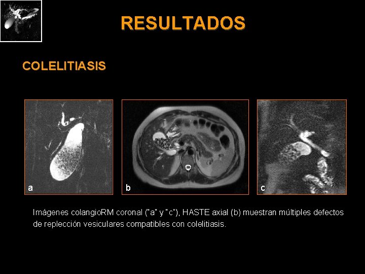 RESULTADOS COLELITIASIS a b c Imágenes colangio. RM coronal (“a” y “c”), HASTE axial