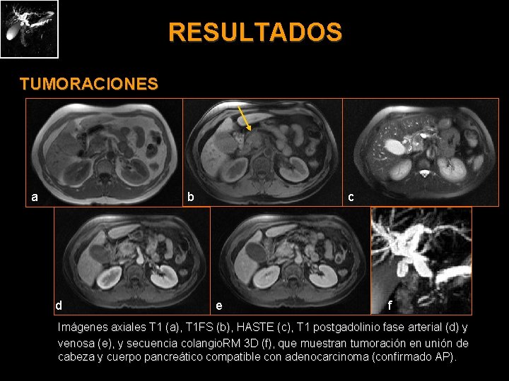 RESULTADOS TUMORACIONES a b d c e f Imágenes axiales T 1 (a), T