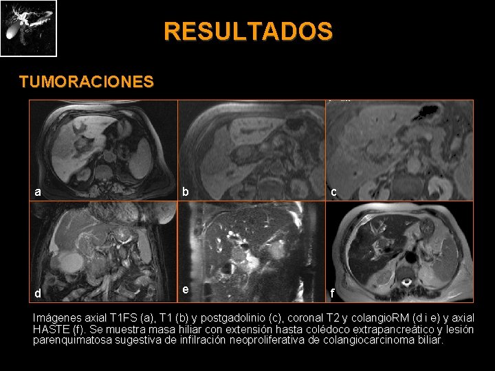 RESULTADOS TUMORACIONES a b c d e f Imágenes axial T 1 FS (a),