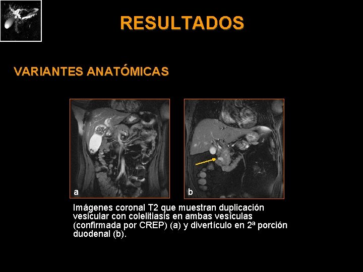 RESULTADOS VARIANTES ANATÓMICAS a b Imágenes coronal T 2 que muestran duplicación vesicular con