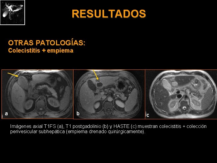 RESULTADOS OTRAS PATOLOGÍAS: Colecistitis + empiema a b c Imágenes axial T 1 FS