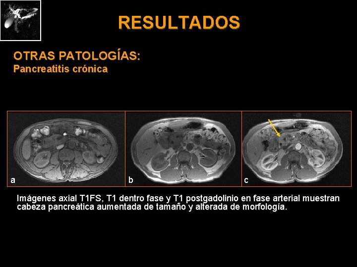 RESULTADOS OTRAS PATOLOGÍAS: Pancreatitis crónica a b c Imágenes axial T 1 FS, T