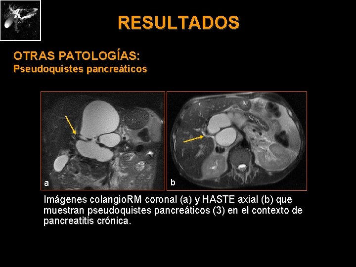 RESULTADOS OTRAS PATOLOGÍAS: Pseudoquistes pancreáticos a b Imágenes colangio. RM coronal (a) y HASTE