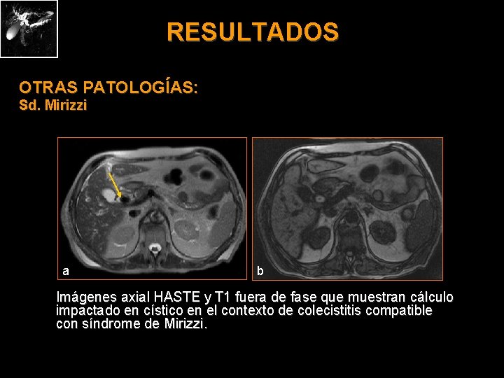 RESULTADOS OTRAS PATOLOGÍAS: Sd. Mirizzi a b Imágenes axial HASTE y T 1 fuera