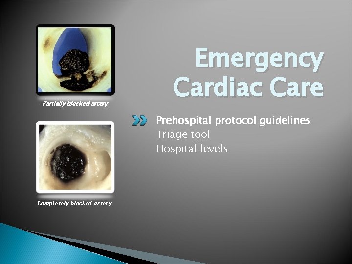 Partially blocked artery Emergency Cardiac Care Prehospital protocol guidelines Triage tool Hospital levels Completely