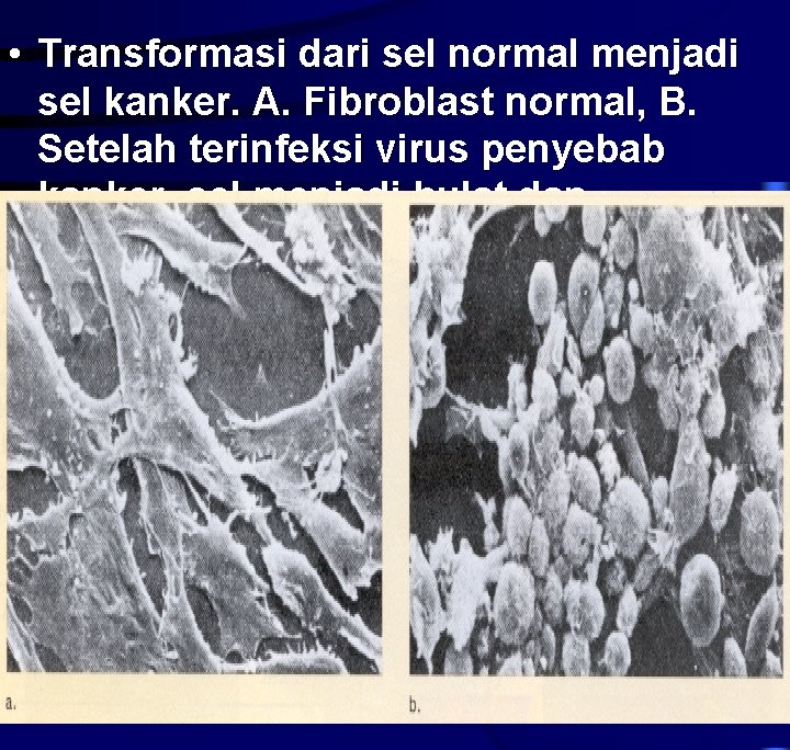  • Transformasi dari sel normal menjadi sel kanker. A. Fibroblast normal, B. Setelah