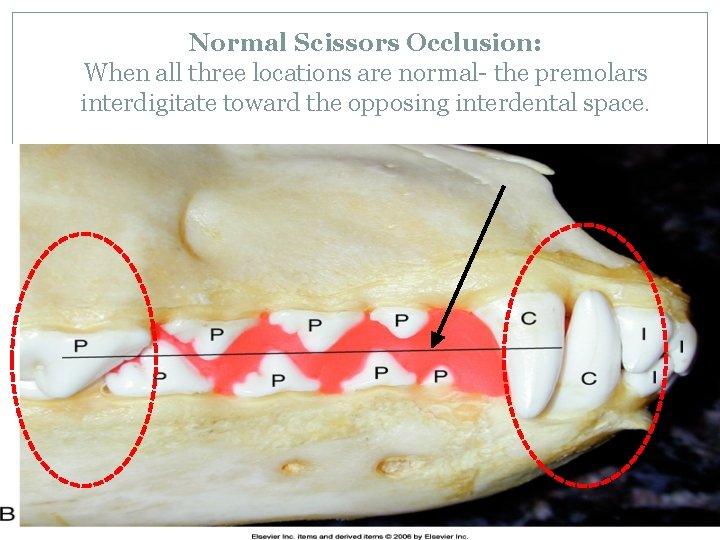 Normal Scissors Occlusion: When all three locations are normal- the premolars interdigitate toward the