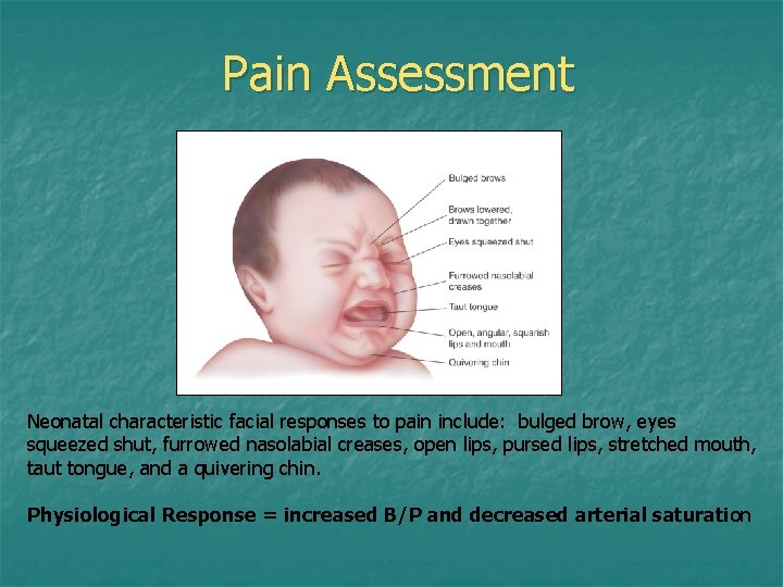 Pain Assessment Neonatal characteristic facial responses to pain include: bulged brow, eyes squeezed shut, Pain Assessment Neonatal characteristic facial responses to pain include: bulged brow, eyes squeezed shut,