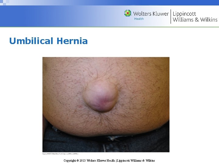 Umbilical Hernia Copyright © 2013 Wolters Kluwer Health | Lippincott Williams & Wilkins 