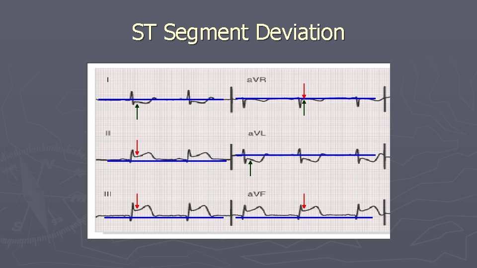 ST Segment Deviation ST Segment Deviation