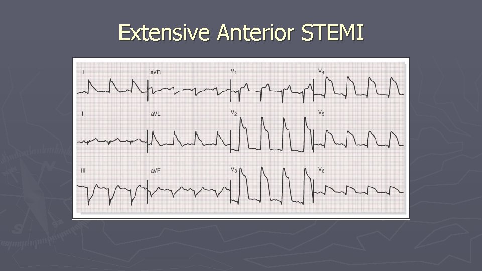 Extensive Anterior STEMI Extensive Anterior STEMI