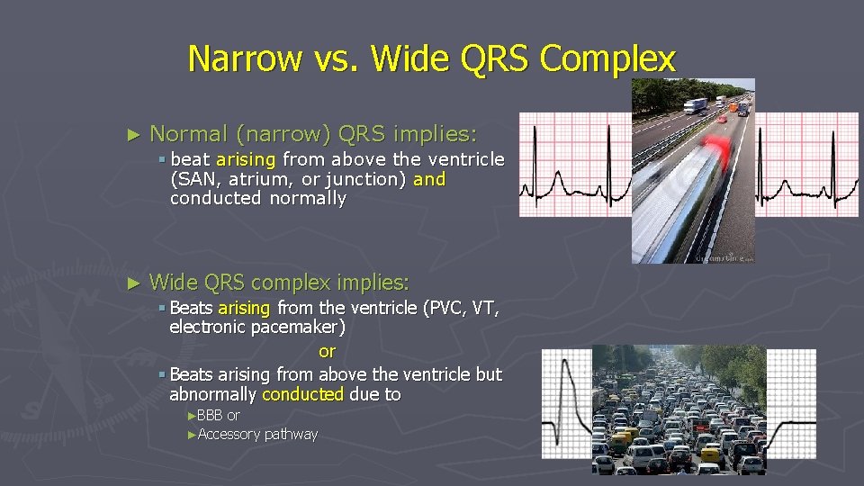 Narrow vs. Wide QRS Complex ► Normal (narrow) QRS implies: § beat arising from Narrow vs. Wide QRS Complex ► Normal (narrow) QRS implies: § beat arising from