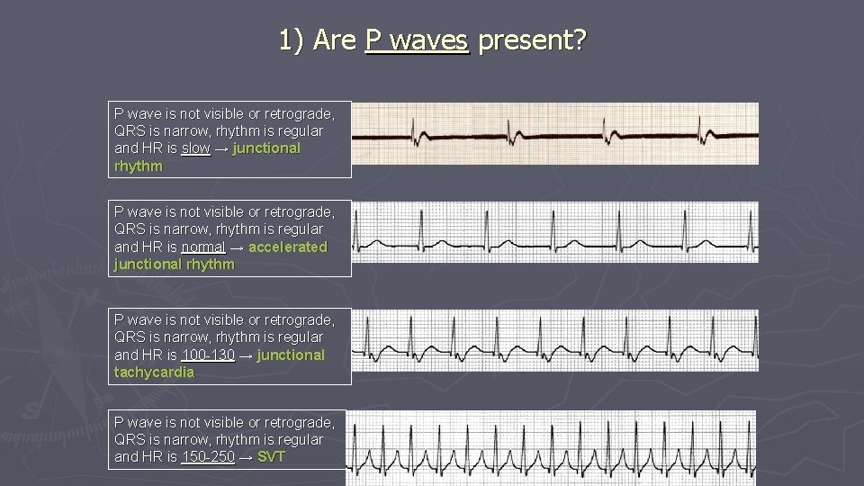 1) Are P waves present? P wave is not visible or retrograde, QRS is 1) Are P waves present? P wave is not visible or retrograde, QRS is