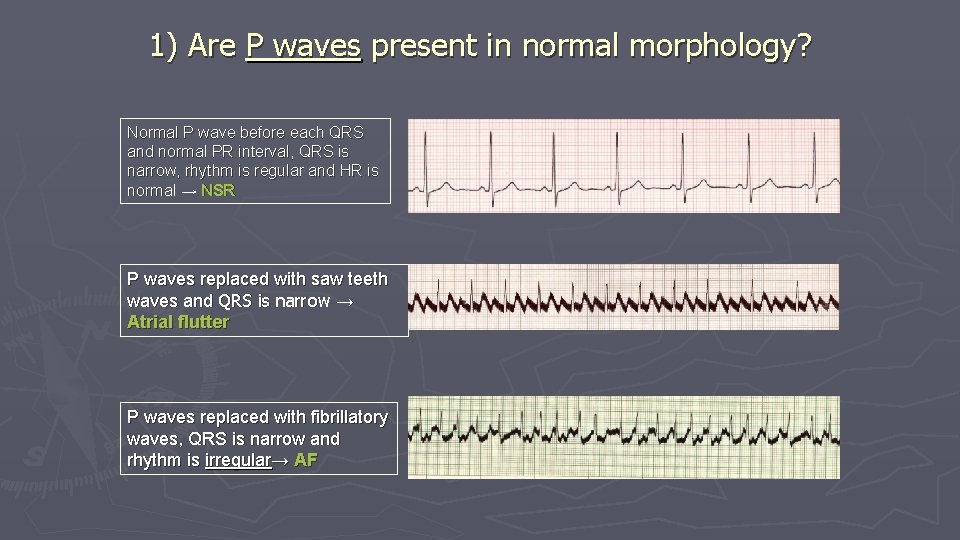 1) Are P waves present in normal morphology? Normal P wave before each QRS 1) Are P waves present in normal morphology? Normal P wave before each QRS