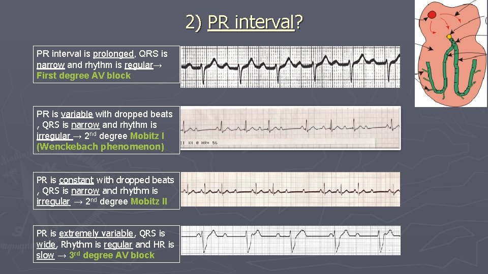 2) PR interval? PR interval is prolonged, QRS is narrow and rhythm is regular→ 2) PR interval? PR interval is prolonged, QRS is narrow and rhythm is regular→