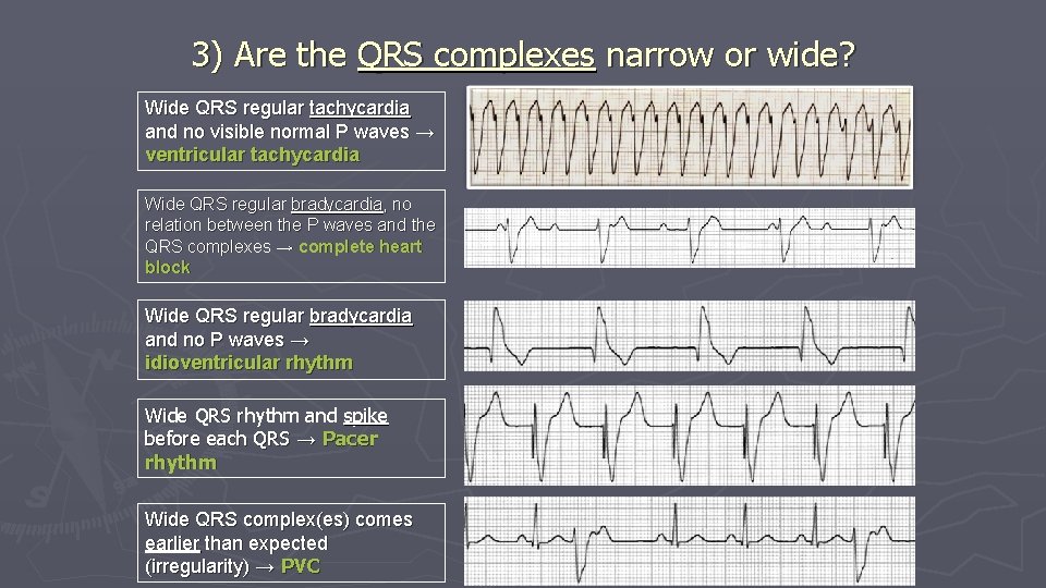 3) Are the QRS complexes narrow or wide? Wide QRS regular tachycardia and no 3) Are the QRS complexes narrow or wide? Wide QRS regular tachycardia and no