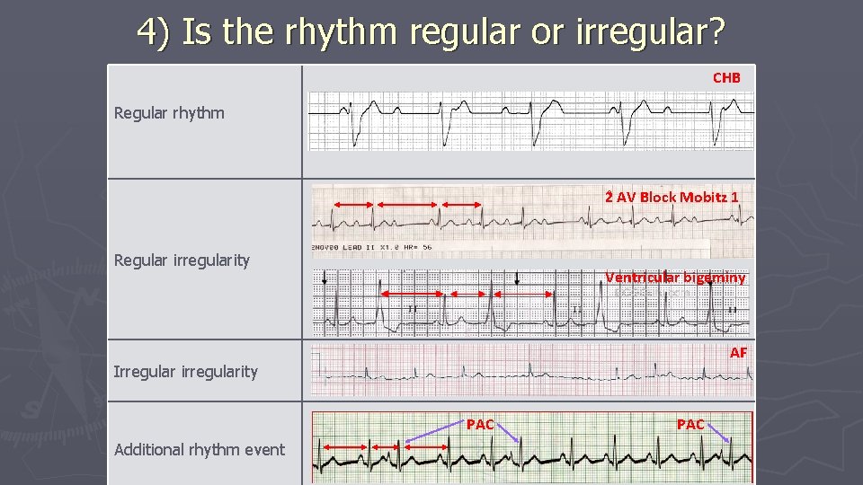 4) Is the rhythm regular or irregular? CHB Regular rhythm 2 AV Block Mobitz 4) Is the rhythm regular or irregular? CHB Regular rhythm 2 AV Block Mobitz