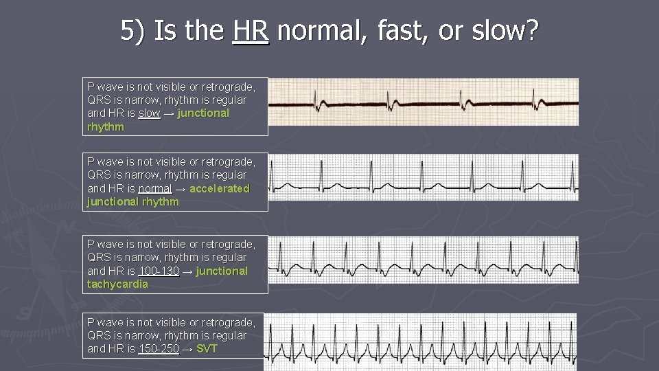 5) Is the HR normal, fast, or slow? P wave is not visible or 5) Is the HR normal, fast, or slow? P wave is not visible or
