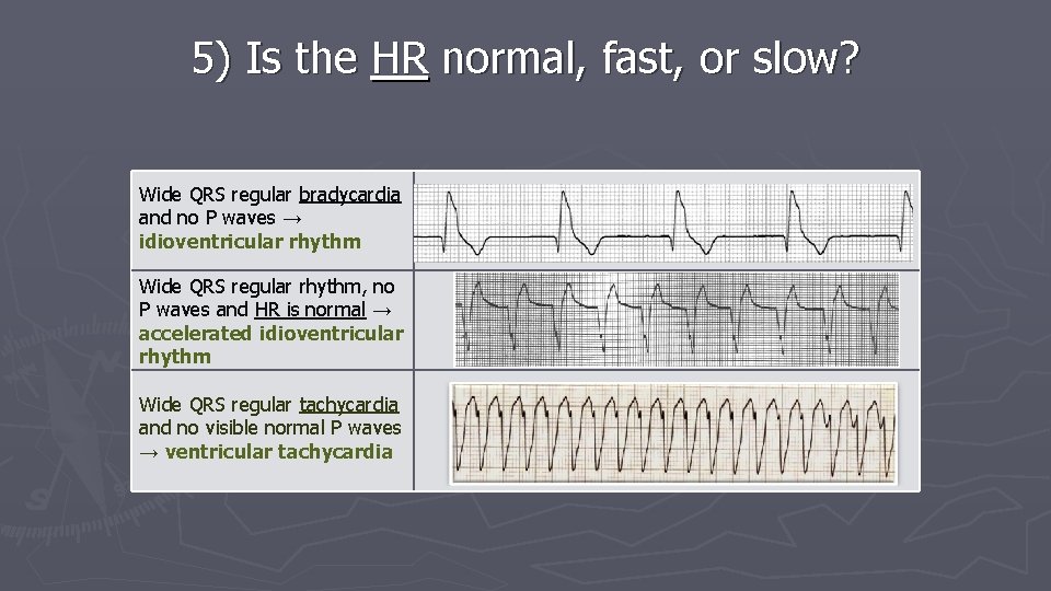 5) Is the HR normal, fast, or slow? Wide QRS regular bradycardia and no 5) Is the HR normal, fast, or slow? Wide QRS regular bradycardia and no