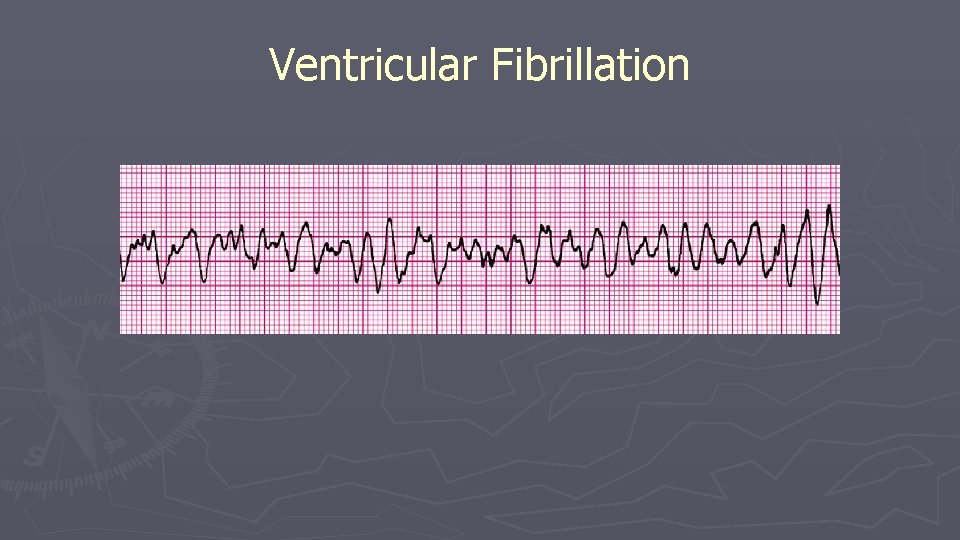Ventricular Fibrillation Ventricular Fibrillation