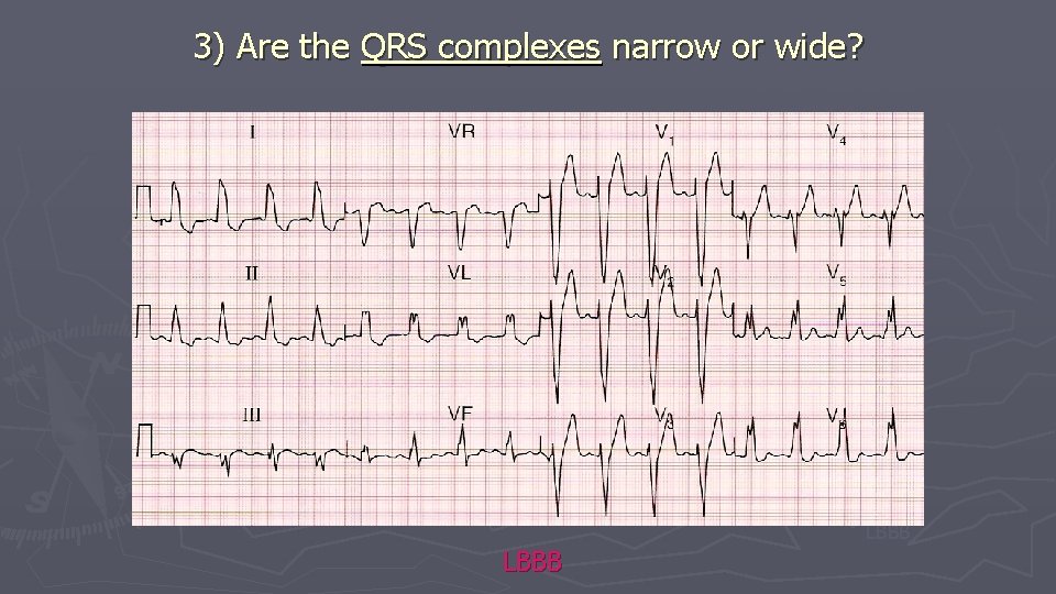 3) Are the QRS complexes narrow or wide? Sinus Tachycardia AF SVT VT Pacemaker 3) Are the QRS complexes narrow or wide? Sinus Tachycardia AF SVT VT Pacemaker