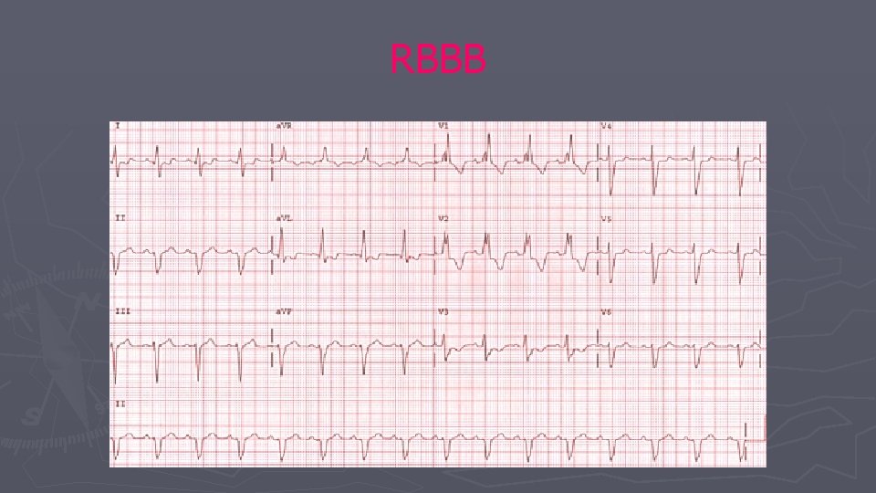 RBBB RBBB