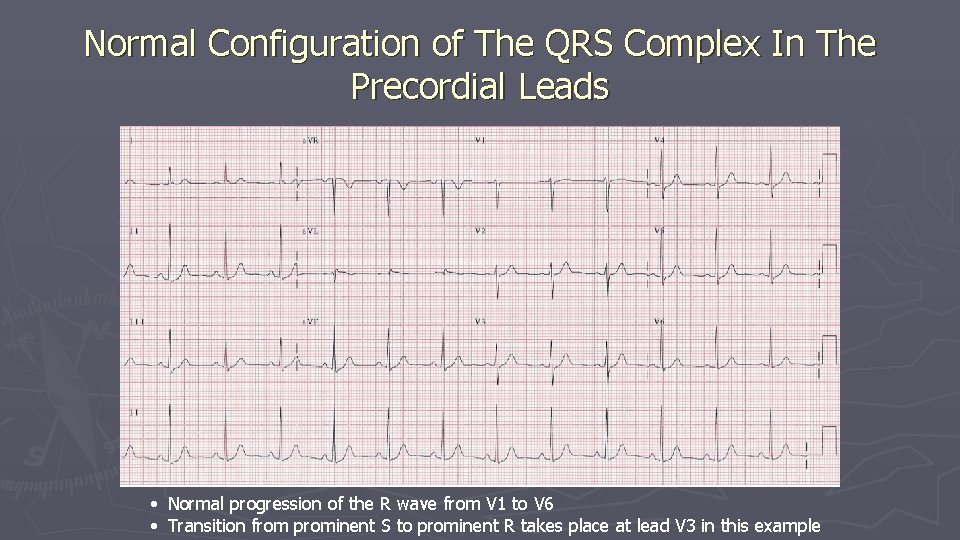 Normal Configuration of The QRS Complex In The Precordial Leads • Normal progression of Normal Configuration of The QRS Complex In The Precordial Leads • Normal progression of