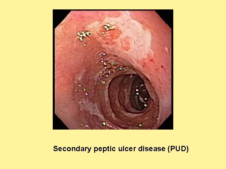 Secondary peptic ulcer disease (PUD) 