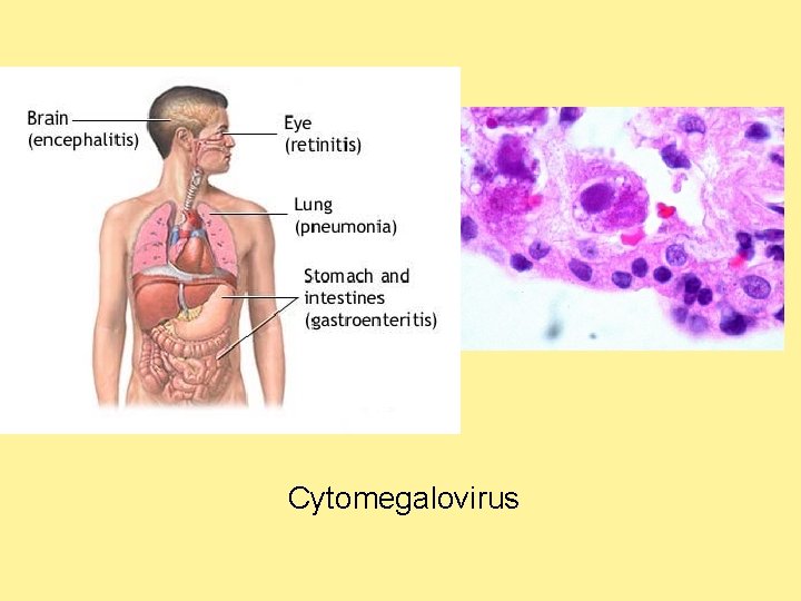 Cytomegalovirus 