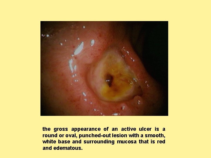 the gross appearance of an active ulcer is a round or oval, punched-out lesion