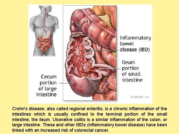 Crohn's disease, also called regional enteritis, is a chronic inflammation of the intestines which