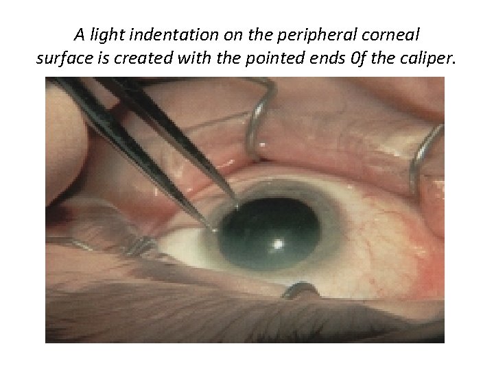 A light indentation on the peripheral corneal surface is created with the pointed ends