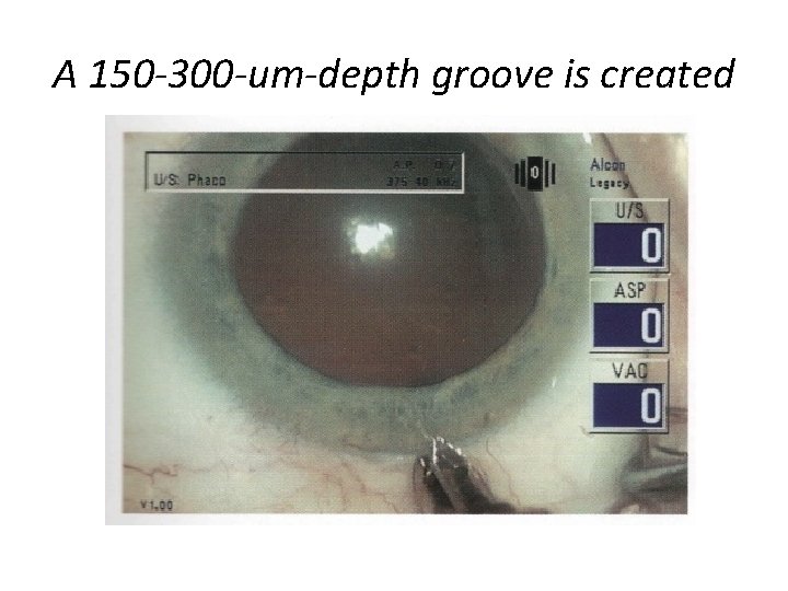 A 150 -300 -um-depth groove is created 