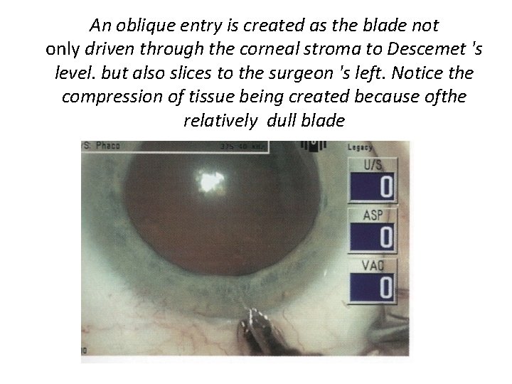 An oblique entry is created as the blade not only driven through the corneal