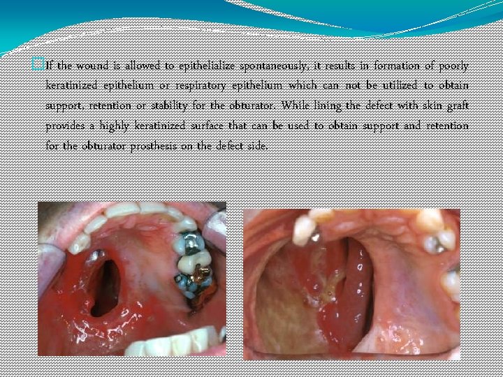 �If the wound is allowed to epithelialize spontaneously, it results in formation of poorly