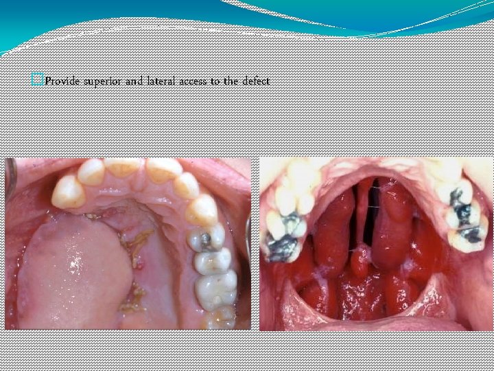 �Provide superior and lateral access to the defect 