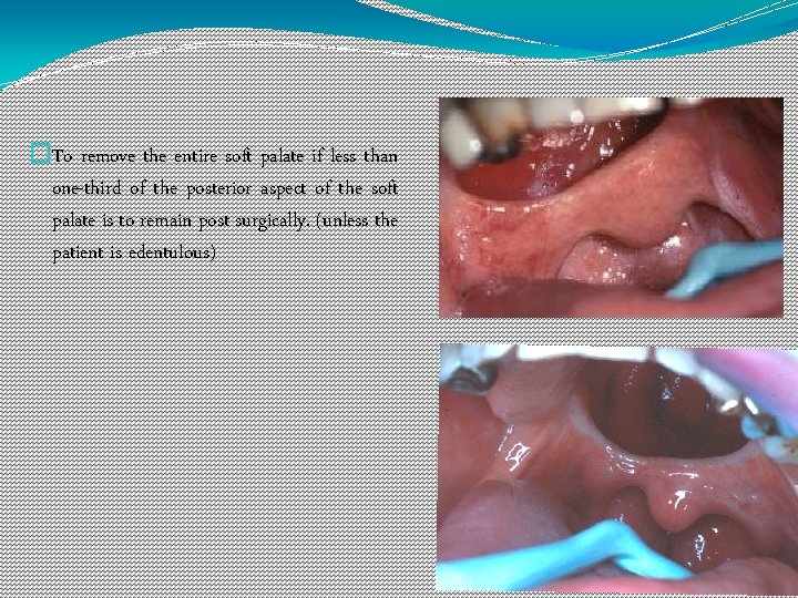 �To remove the entire soft palate if less than one-third of the posterior aspect