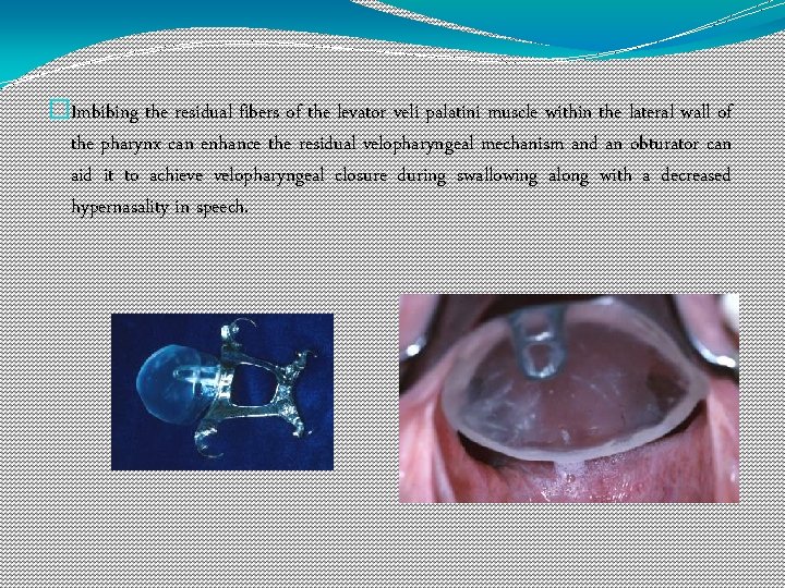 �Imbibing the residual fibers of the levator veli palatini muscle within the lateral wall