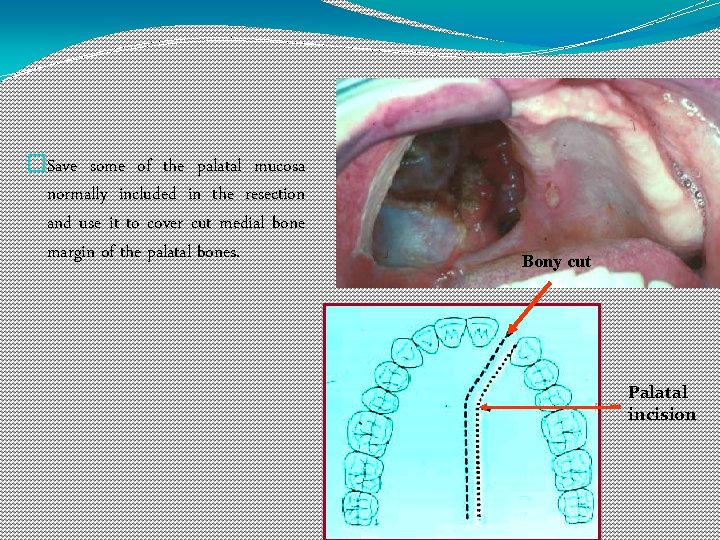 �Save some of the palatal mucosa normally included in the resection and use it