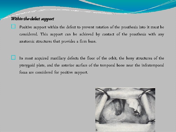 Within-the-defect support � Positive support within the defect to prevent rotation of the prosthesis