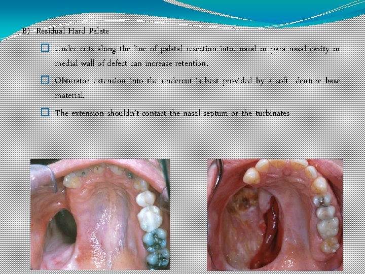 B) Residual Hard Palate � Under cuts along the line of palatal resection into,