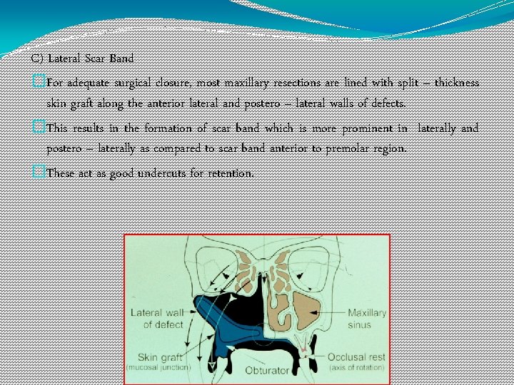 C) Lateral Scar Band �For adequate surgical closure, most maxillary resections are lined with