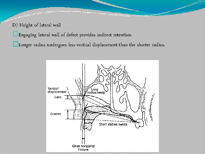 D) Height of lateral wall �Engaging lateral wall of defect provides indirect retention. �Longer